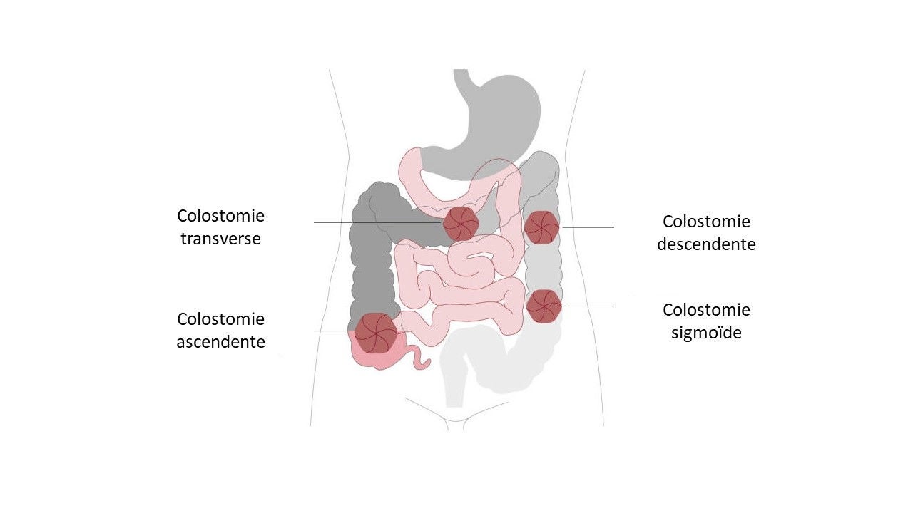 Qu’est-ce Qu’une Stomie ? Explication De La Fonction Et Des Types De ...