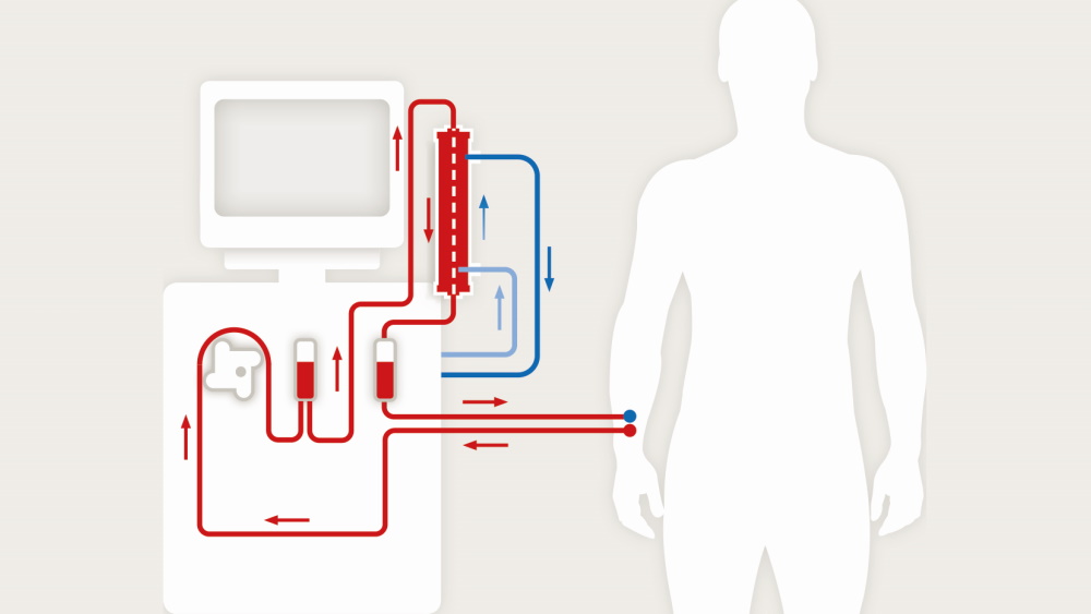 schema hemodialyse fonctionnement